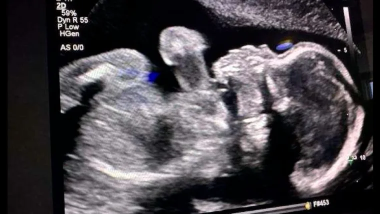 Brain-Dead Mum Kept Alive To Give Birth To Premature Baby