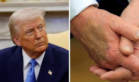 Fears For Donald Trump As He’s Diagnosed With “Horror” Disease