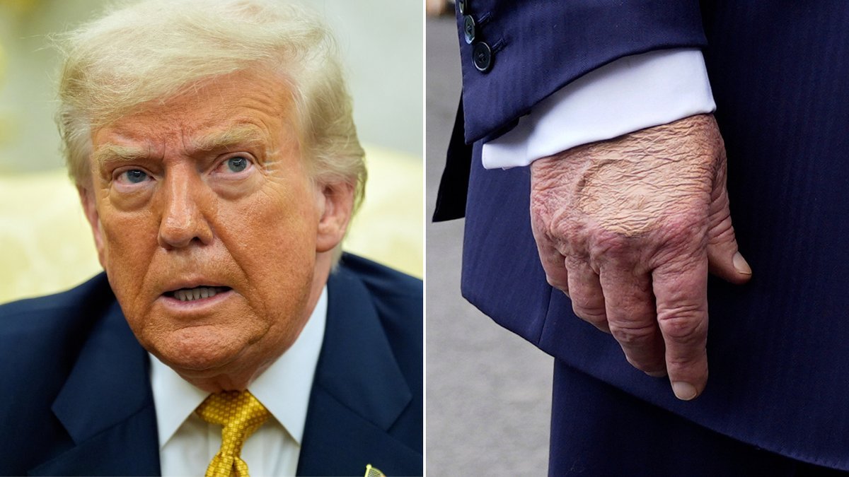 Doctors FEAR Debilitating Condition for Donald Trump image 2