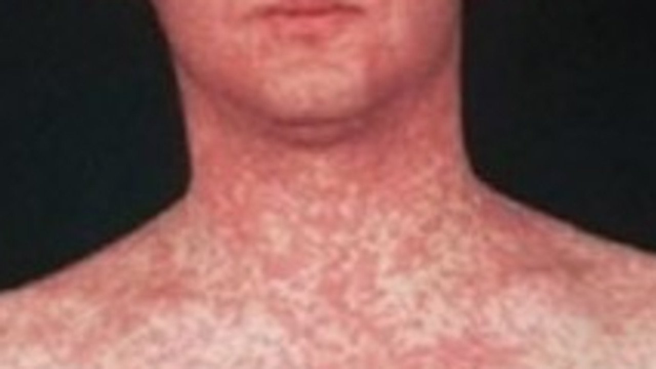 Urgent Measles WARNING issued For One Aussie State image 2