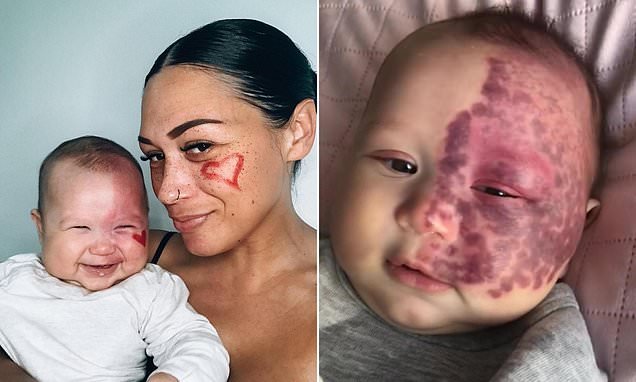 Aussie Mum Slammed For Lasering Her Baby’s Birthmark Share New Photos