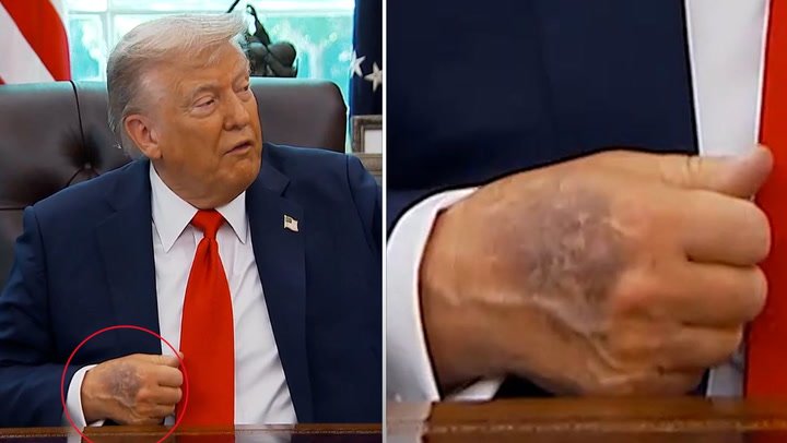 Bombshell Grave Concer For Trump After Image Of His Hand Shared Online second image