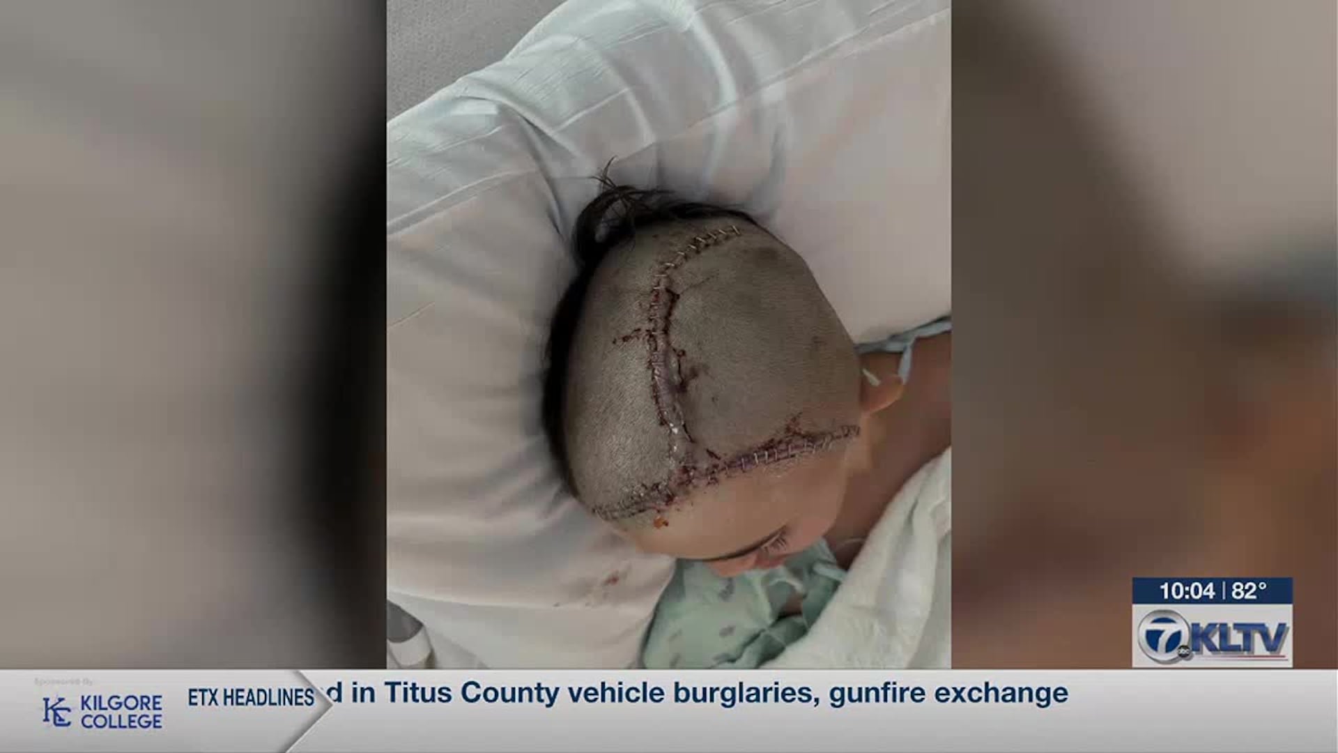 Boy Has Scull Removed After Brutal School Cafeteria Confrontation second image