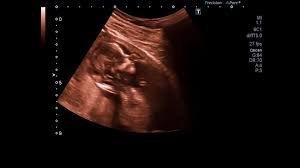 Aussie Couples Forced to Delay Parenthood Amid Soaring House Prices Horror - Second Image