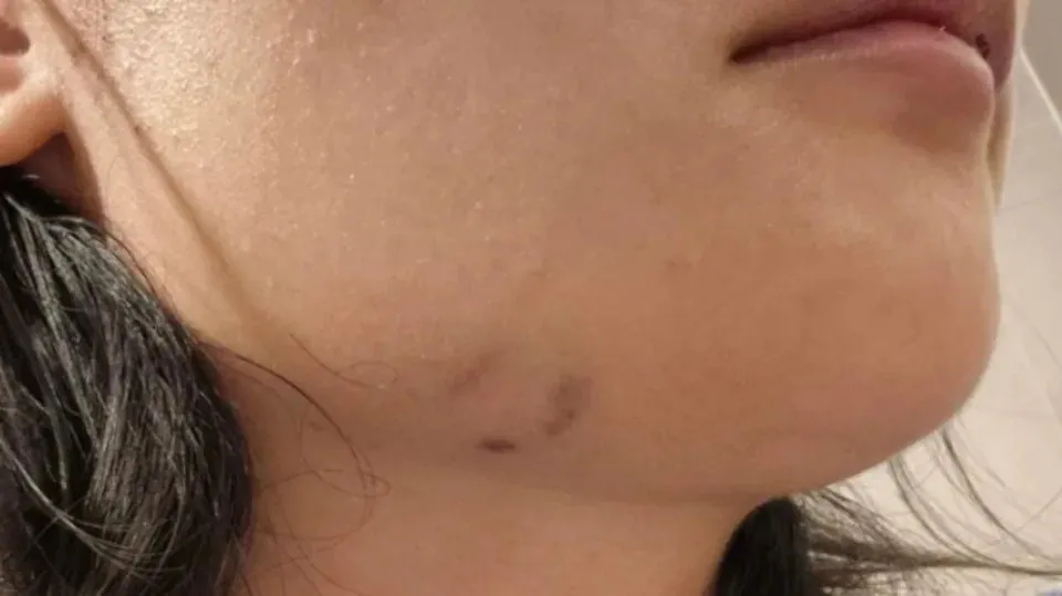 Racial Fury Chinese Woman Bashed in Canberra - Second Image
