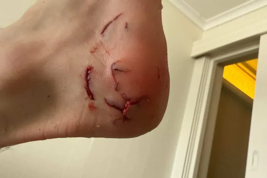 Teen Surfer Mauled by Shark in South Australia - Second Image