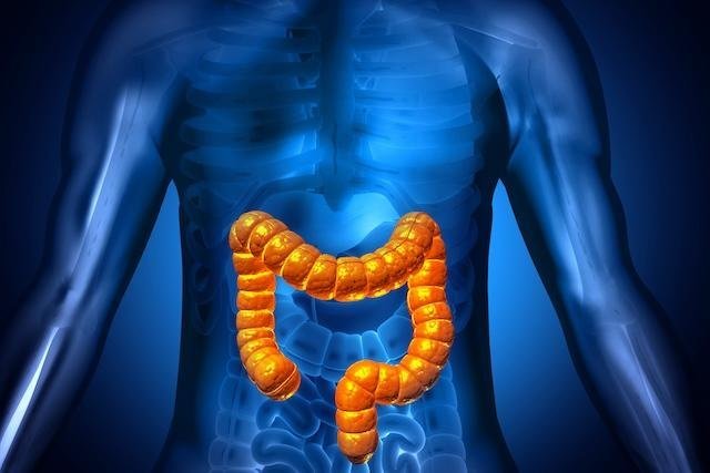 Young Aussies Dying at Alarming Rate from Aggressive Bowel Cancer - Second Image
