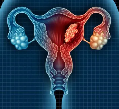 Silent Killer Claims Aussie Lives as Uterine Cancer Cases Double - Second Image