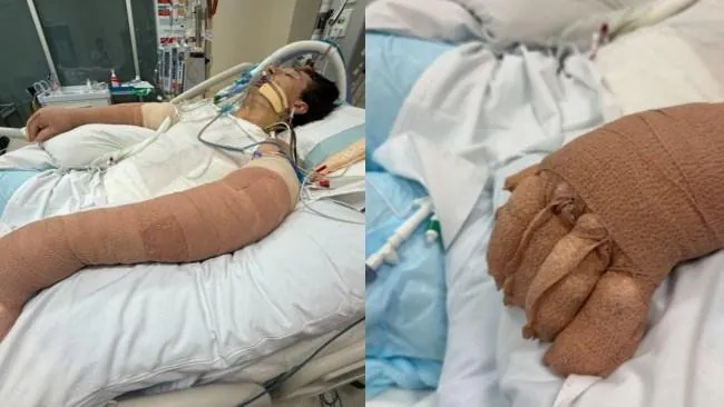 Robotic Vacuum Explodes , Man Fighting for Life