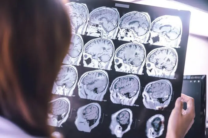 Half of Dementia Cases Can be Prevented, Shock WHO Report Reveals - Second Image