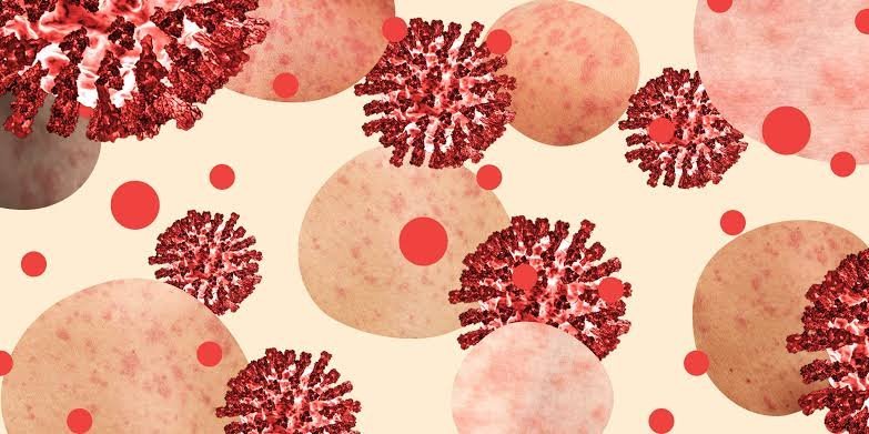 A Biblical Disease Making a Comeback in US