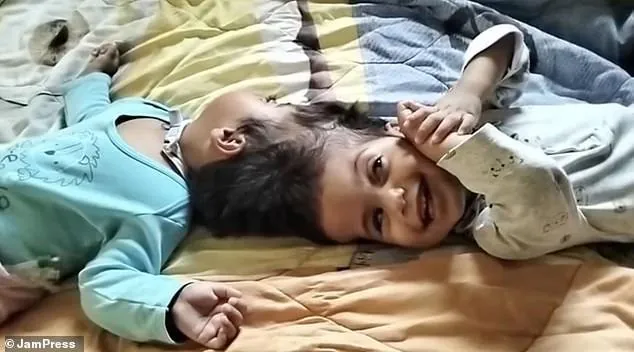 Conjoined Twins Die in Tragic Surgery