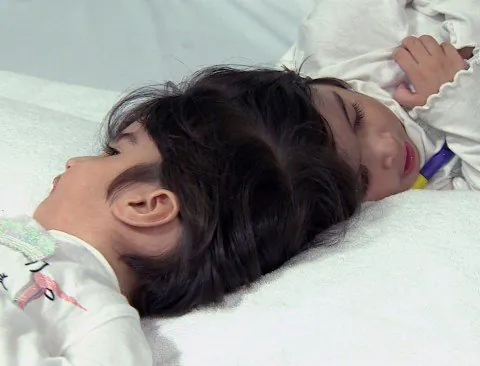 Conjoined Twins Die in Tragic Surgery in Brazil - Second Image